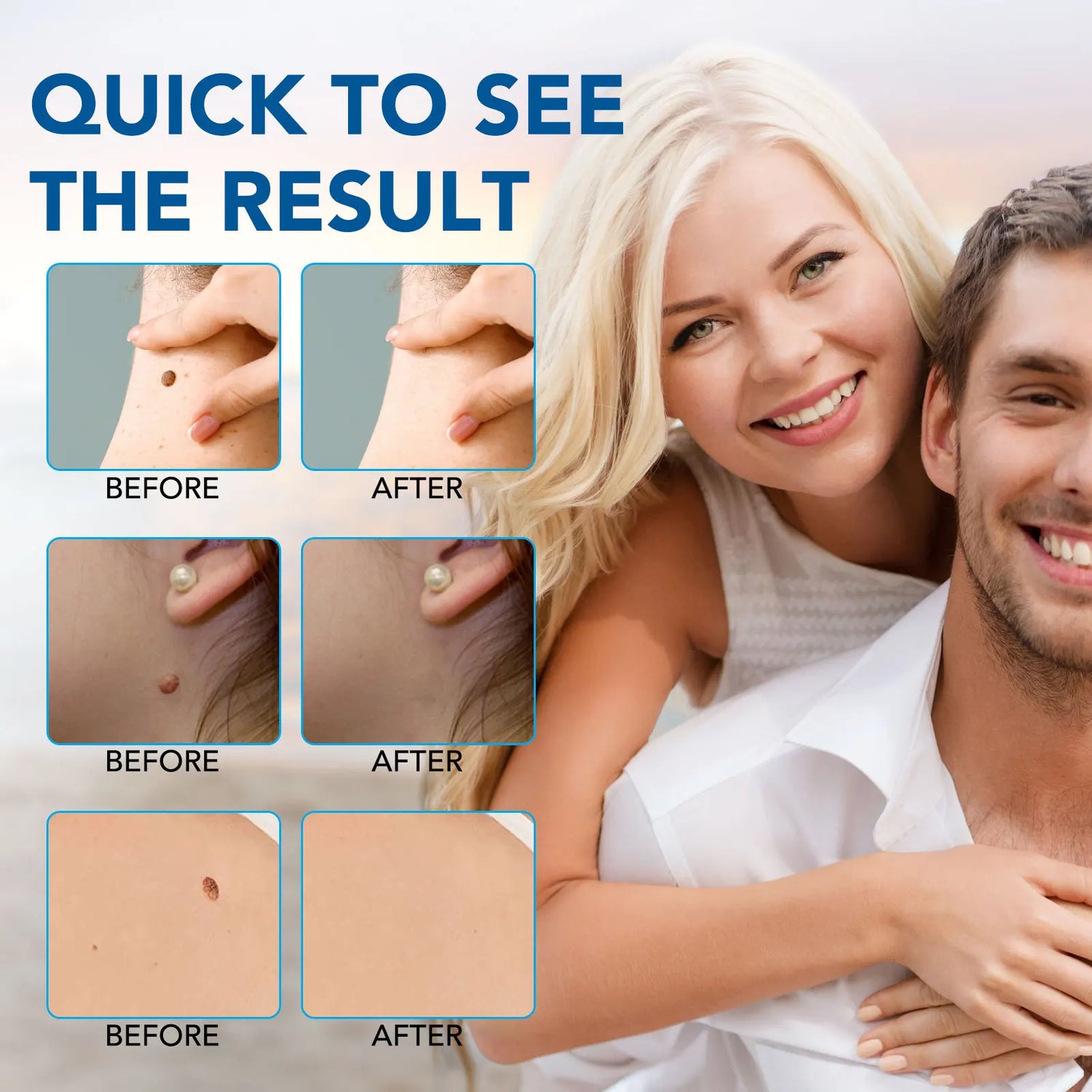 skin tag removal